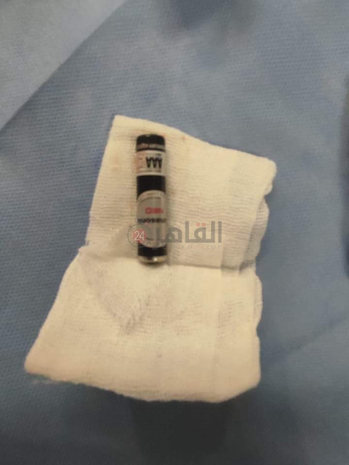 استخراج بطارية من طفلة عمرها 5 سنوات