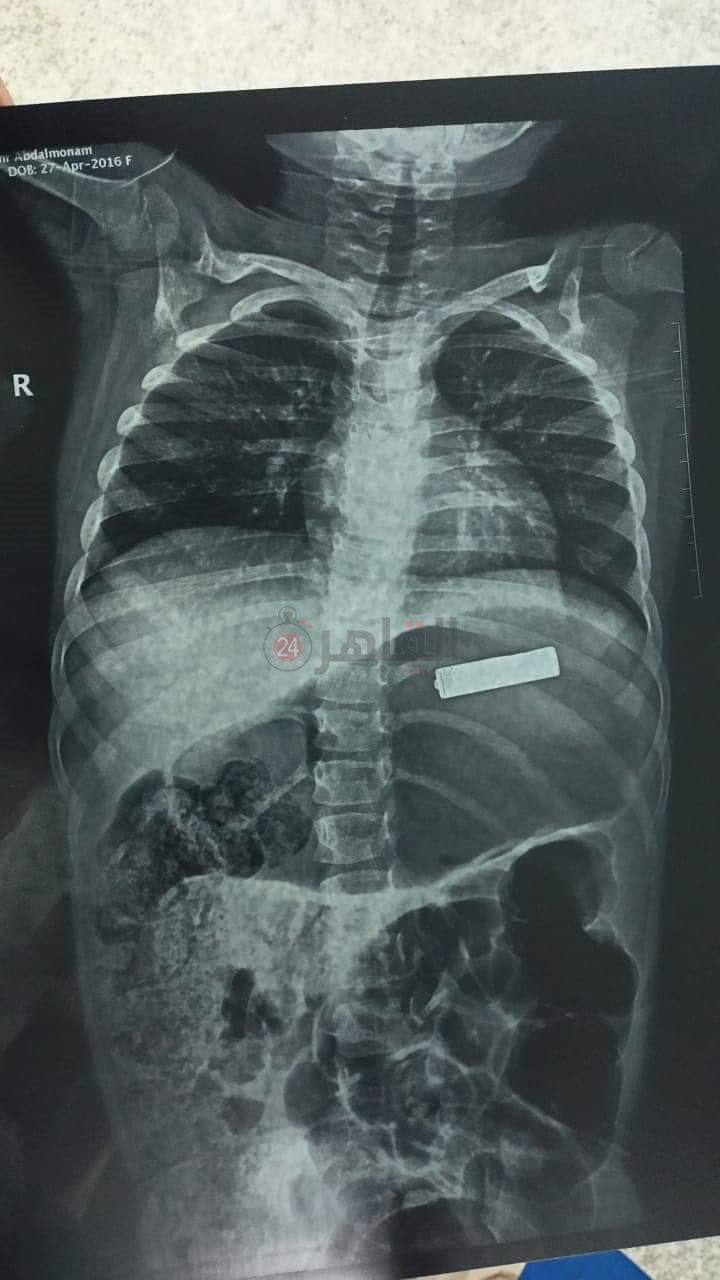 تفاصيل استخراج بطارية من طفلة عمرها 5 سنوات