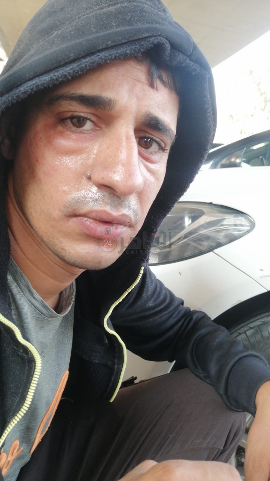 صورة للزوج بعد تعرضه للمادة الحارقة يوم الواقعة