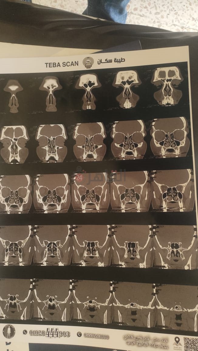 أشعة توضح خطورة حالة العم جلال 02