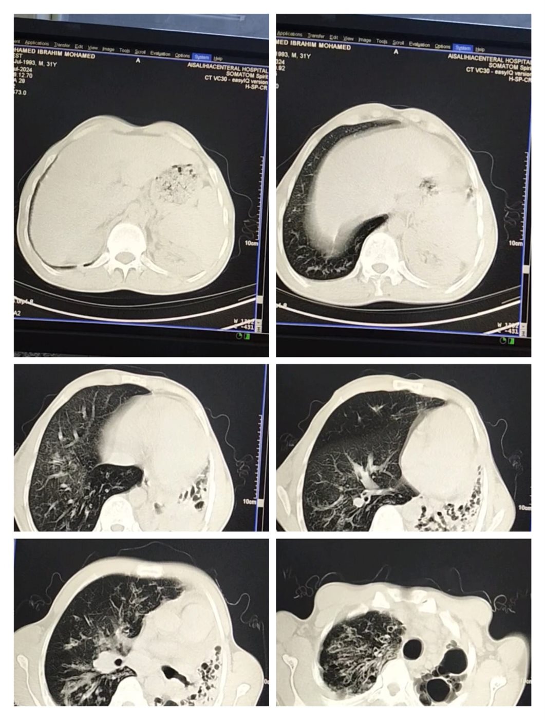 تقرير طبي لحالة محمد إبراهيم مصاب التليف الرئوي 