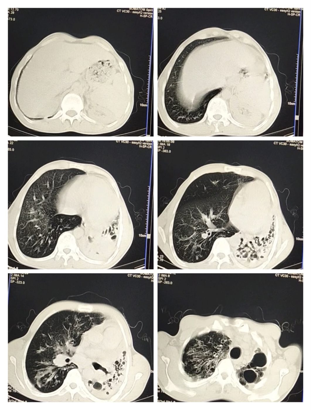 تقرير طبي لحالة محمد إبراهيم مصاب التليف الرئوي 