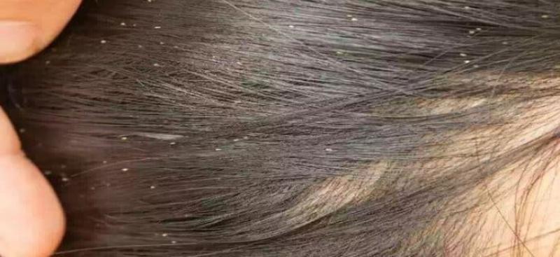 تفسير حلم القمل في الشعر وقتله