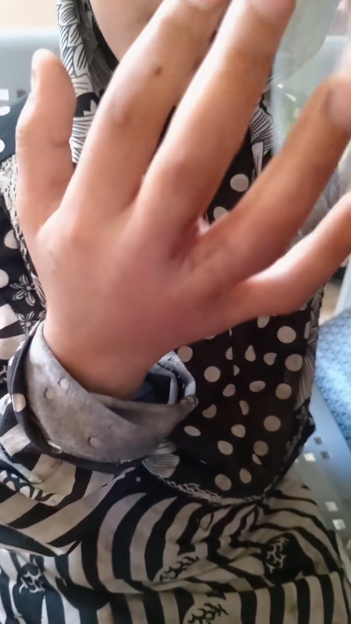 الطفلة ضحية تعذيب والدها في الوادى الجديد