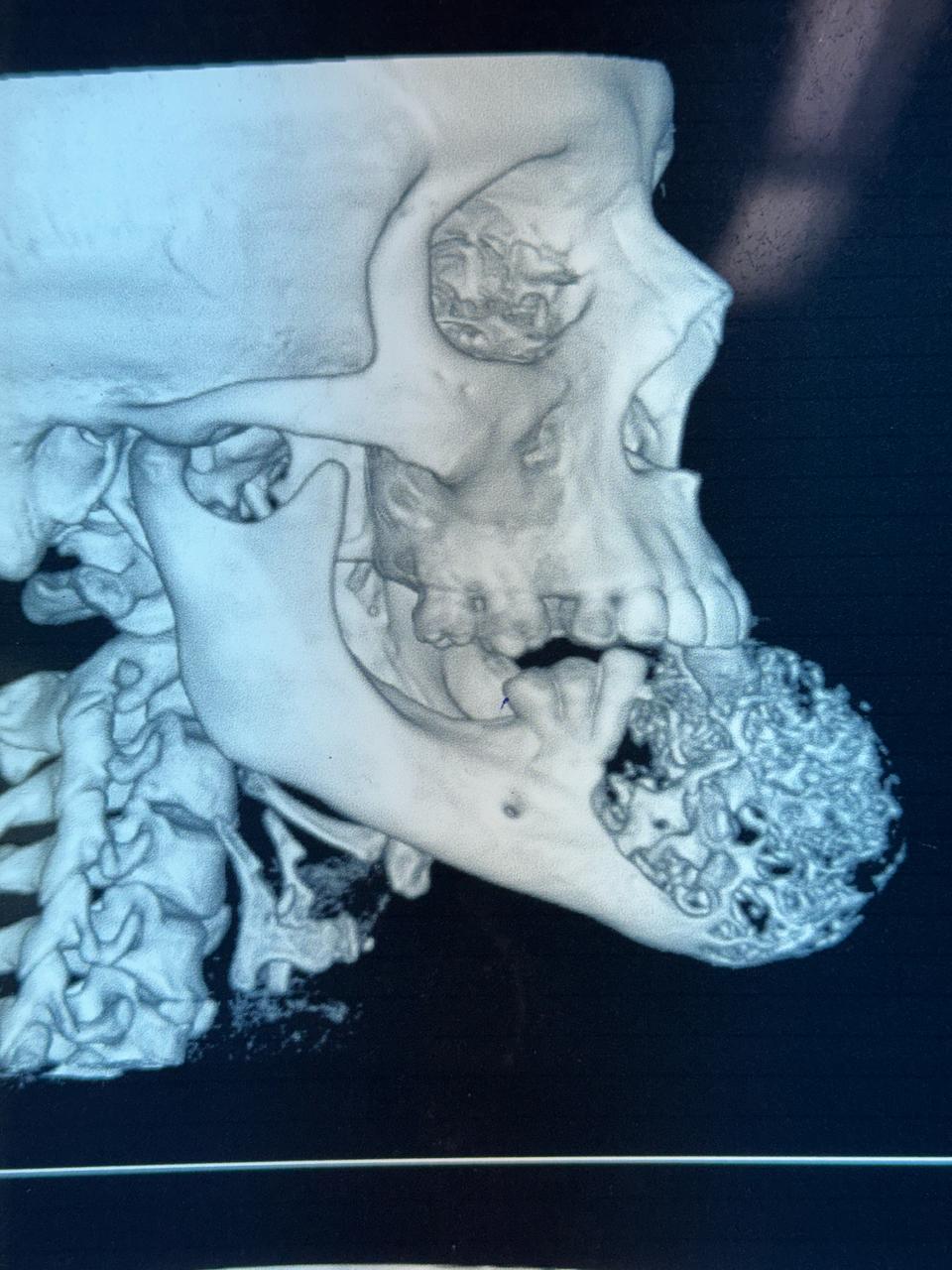 نجاح جراحة دقيقة لإزالة ورم من فك مريضة بمستشفى الشيخ زايد التخصصي