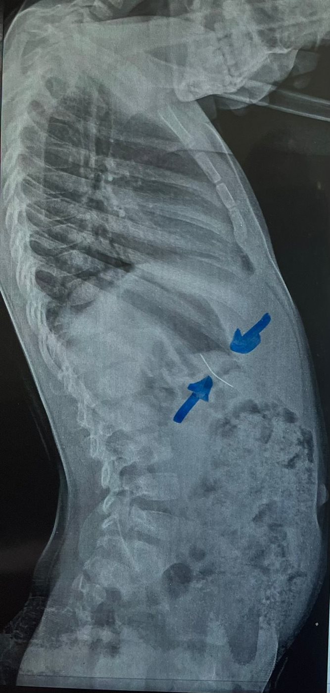 فريق طبي ينجح في استخراج دبوس من معدة صغير 4 سنوات بمستشفى سوهاج الجامعي