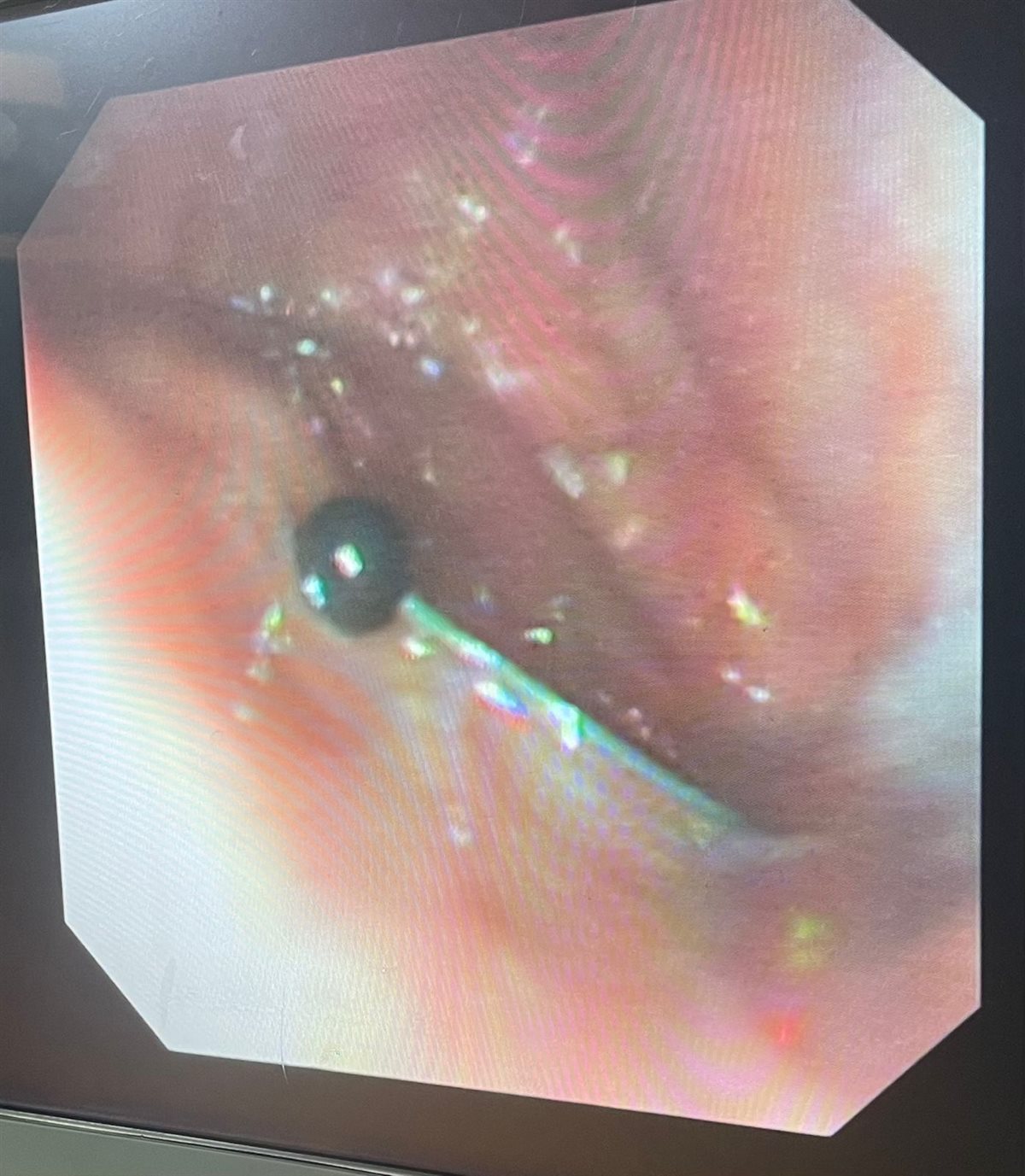 فريق طبي ينجح في استخراج دبوس من معدة صغير 4 سنوات بمستشفى سوهاج الجامعي