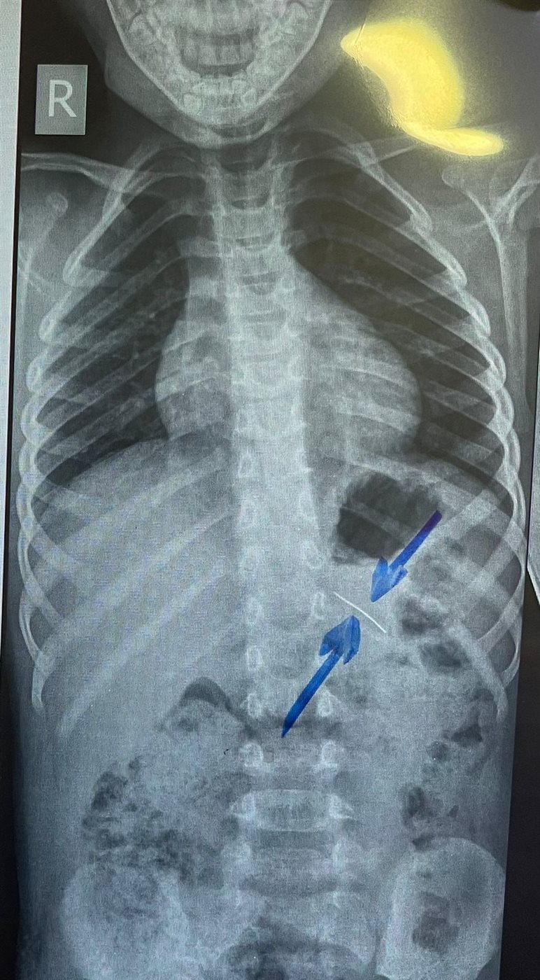 فريق طبي ينجح في استخراج دبوس من معدة صغير 4 سنوات بمستشفى سوهاج الجامعي