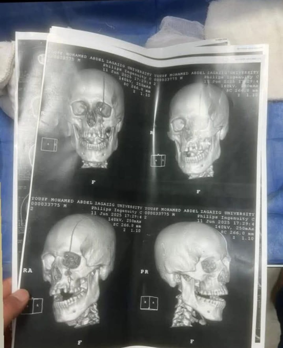 جانب من الاشعة والاصابات