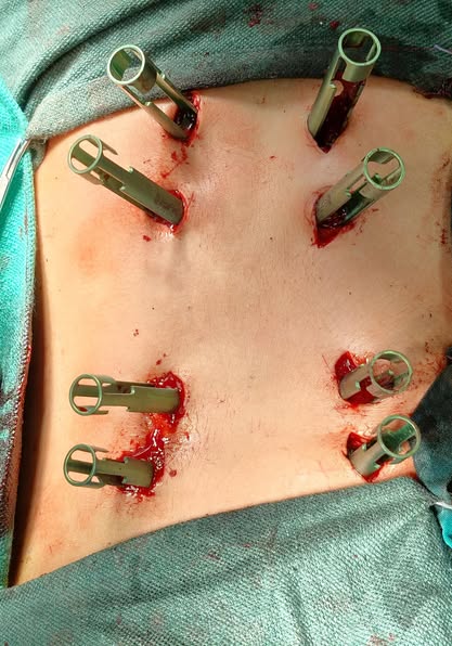 سقط من ارتفاع 7 أمتار.. طب أسيوط الأزهر تجري عملية لتثبيت العمود الفقري باستخدام تقنية التدخل المحدود<br>