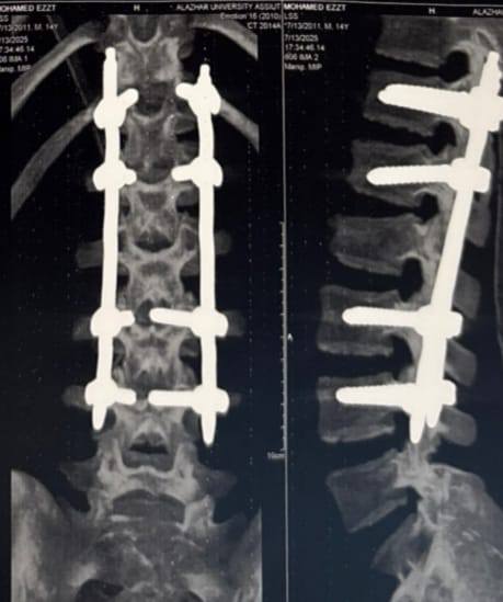 سقط من ارتفاع 7 أمتار.. طب أسيوط الأزهر تجري عملية لتثبيت العمود الفقري باستخدام تقنية التدخل المحدود<br>