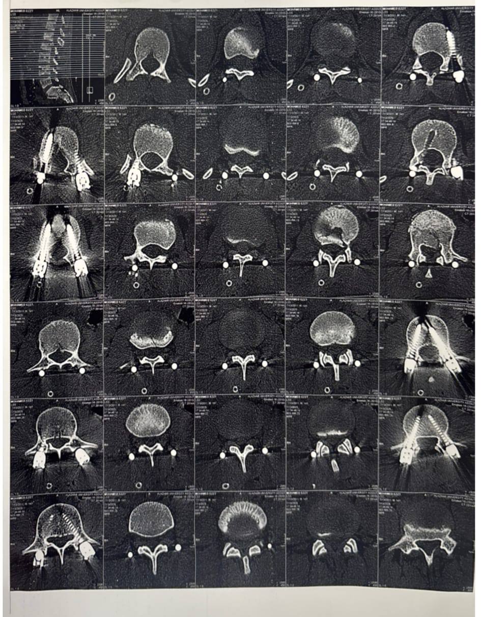 سقط من ارتفاع 7 أمتار.. طب أسيوط الأزهر تجري عملية لتثبيت العمود الفقري باستخدام تقنية التدخل المحدود<br>