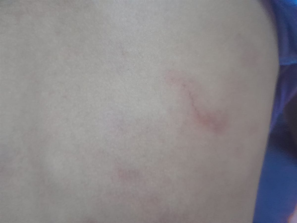 آثار الضرب على الصغير