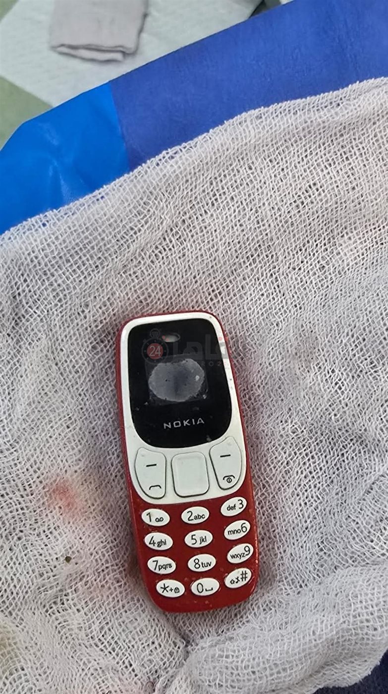 فريق طبي يستخرج تليفون محمول من معدة مريض 