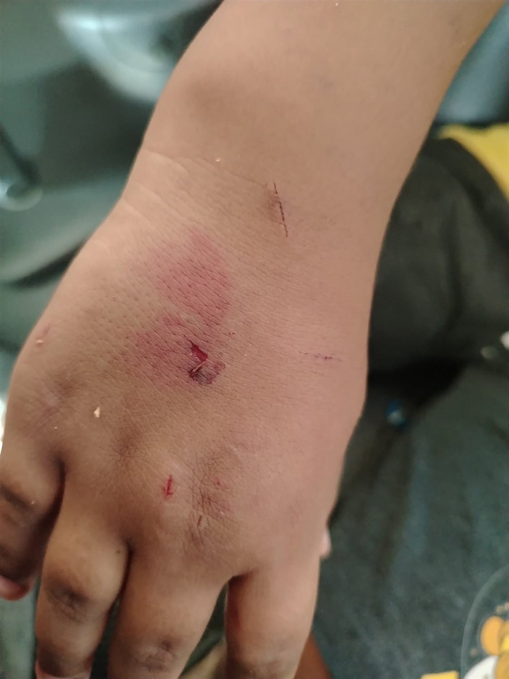 إصابة الطفل