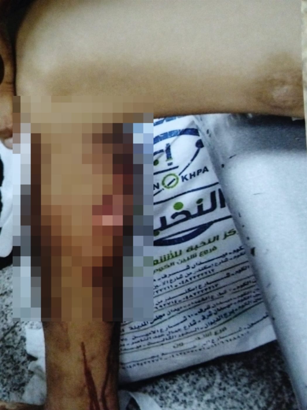  كلب شرس يعقر صغير في فخذه بالسلام 