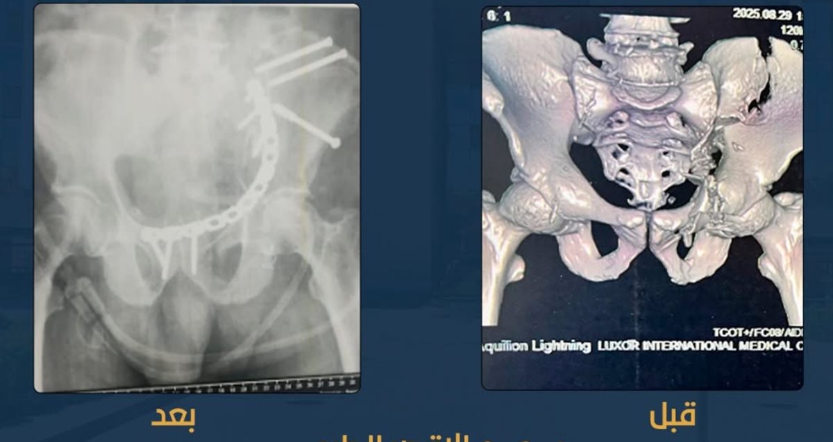 العملية قبل وبعد