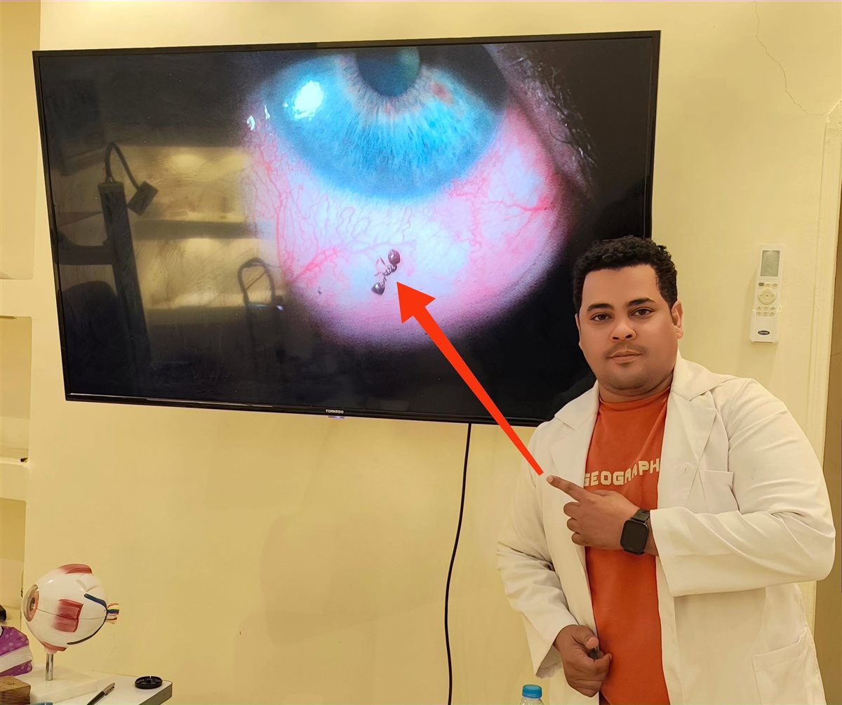 طبيب أقصري ينقذ مريضة من نملة 