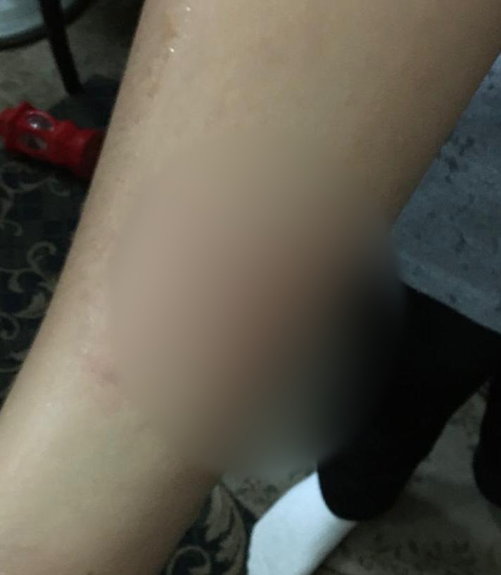 كدمات متفرقة بجسد الطالب