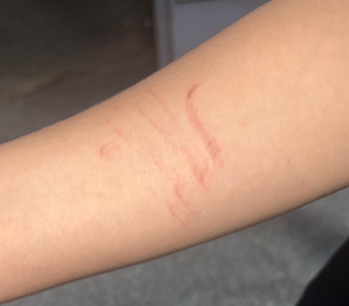 كدمات متفرقة بجسد الطالب