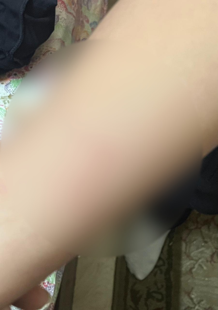 كدمات متفرقة بجسد الطالب