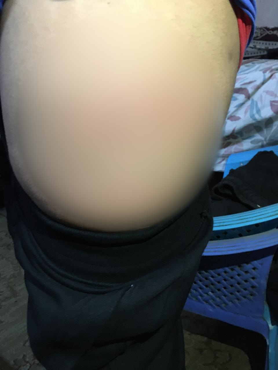 كدمات متفرقة بجسد الطالب