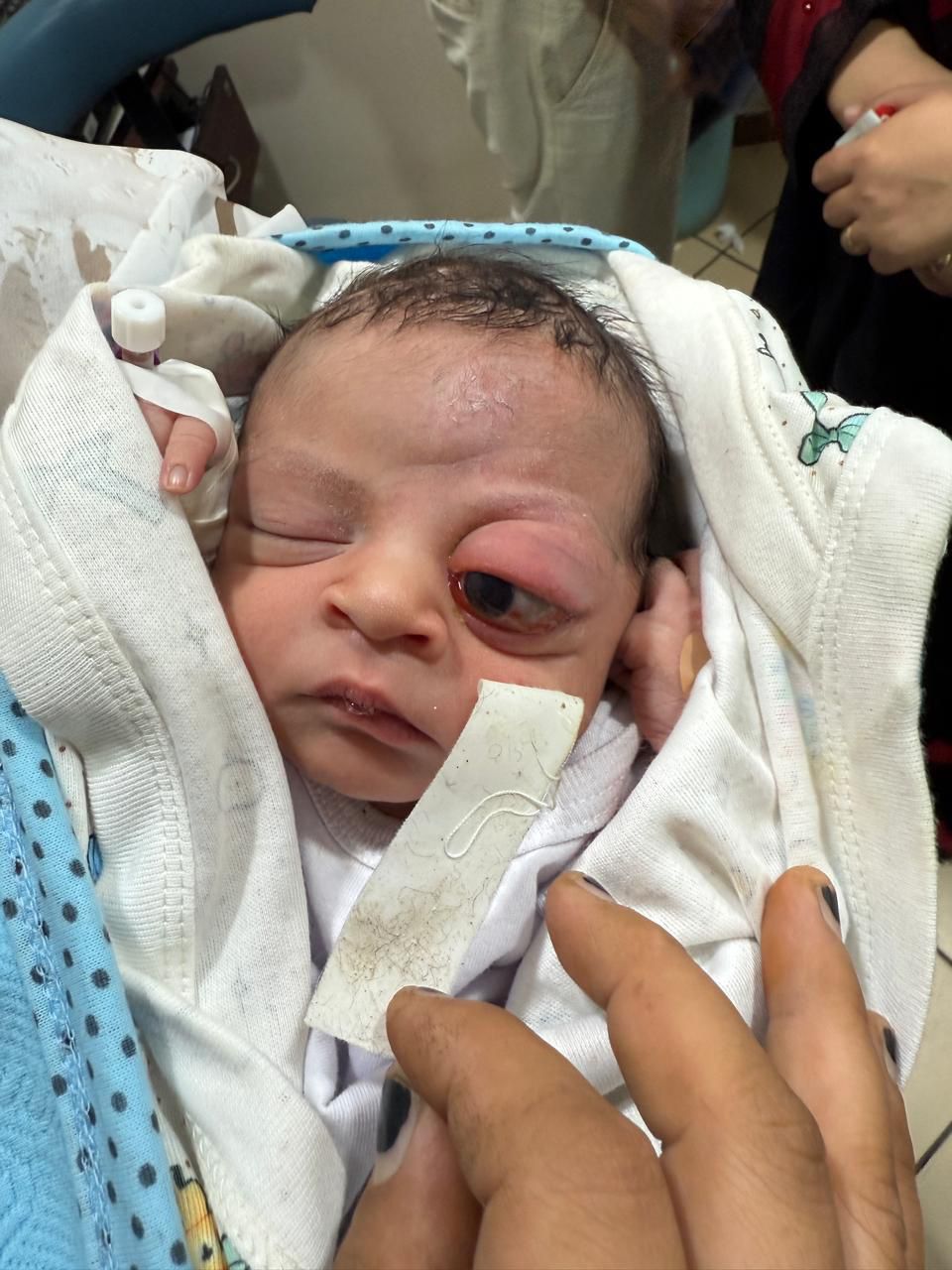 إنقاذ بصر رضيع حديث الولادة يعاني ورم خلف العين