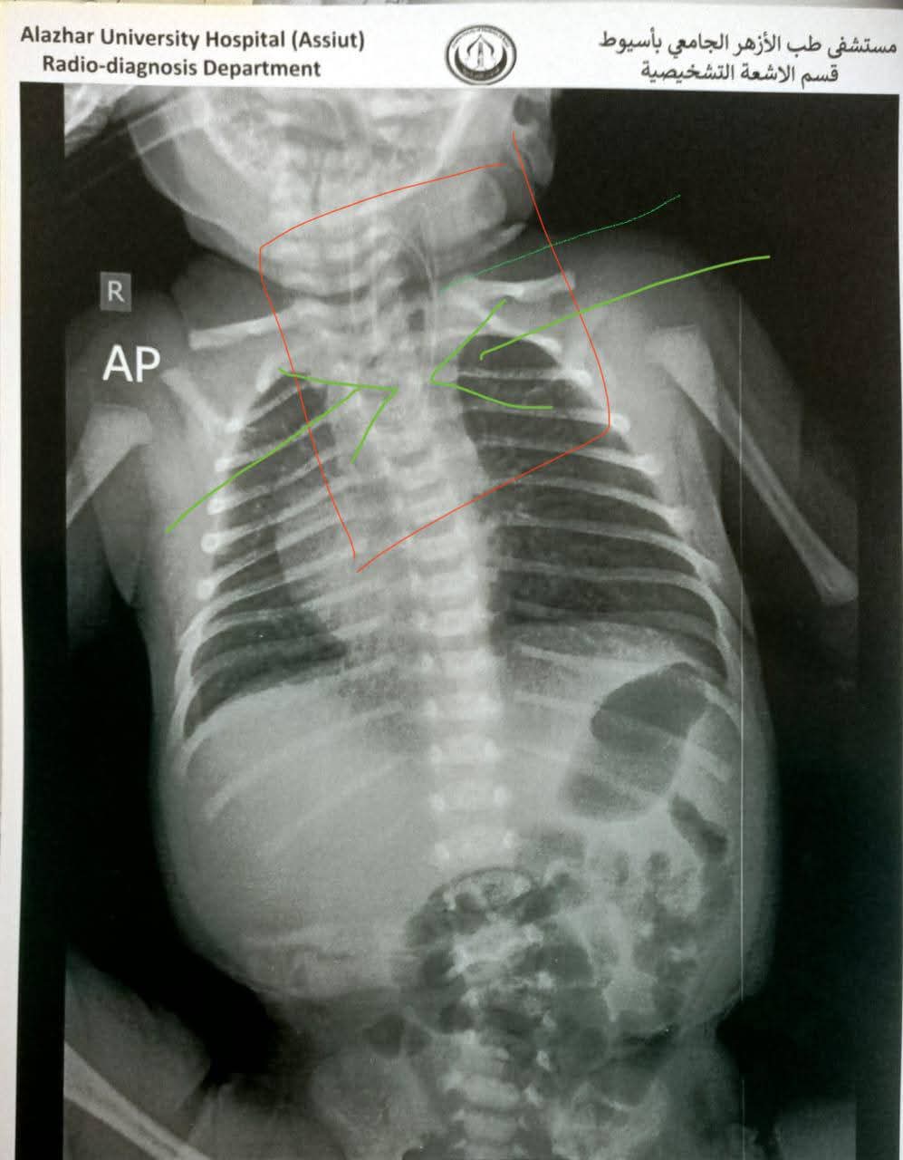 مستشفى جامعة الأزهر بأسيوط ينقذ حياة رضيع 