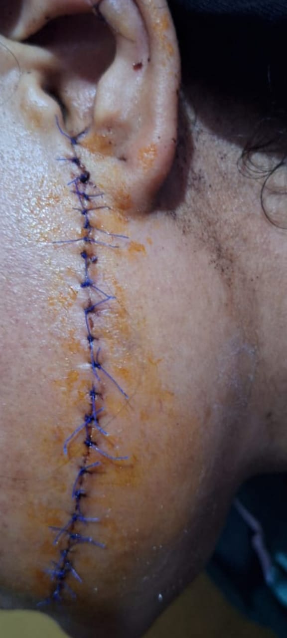 الفتاة بعد إصابتها