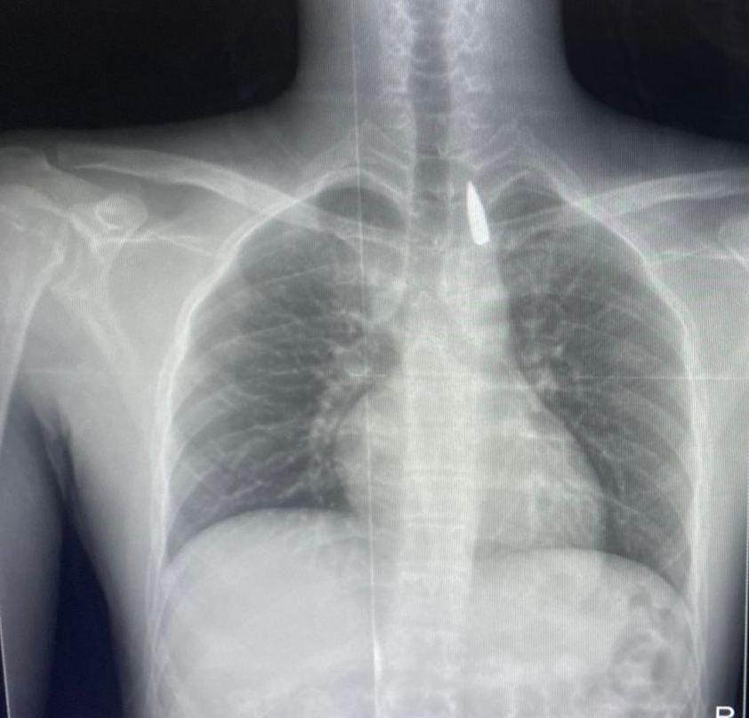 أشعة مكان الرصاصة