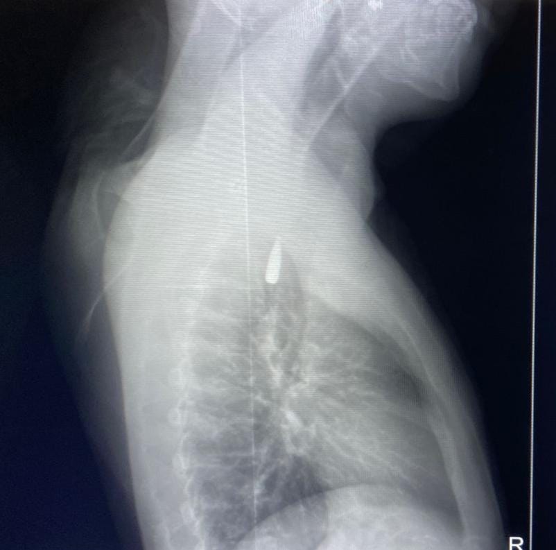 أشعة مكان الرصاصة