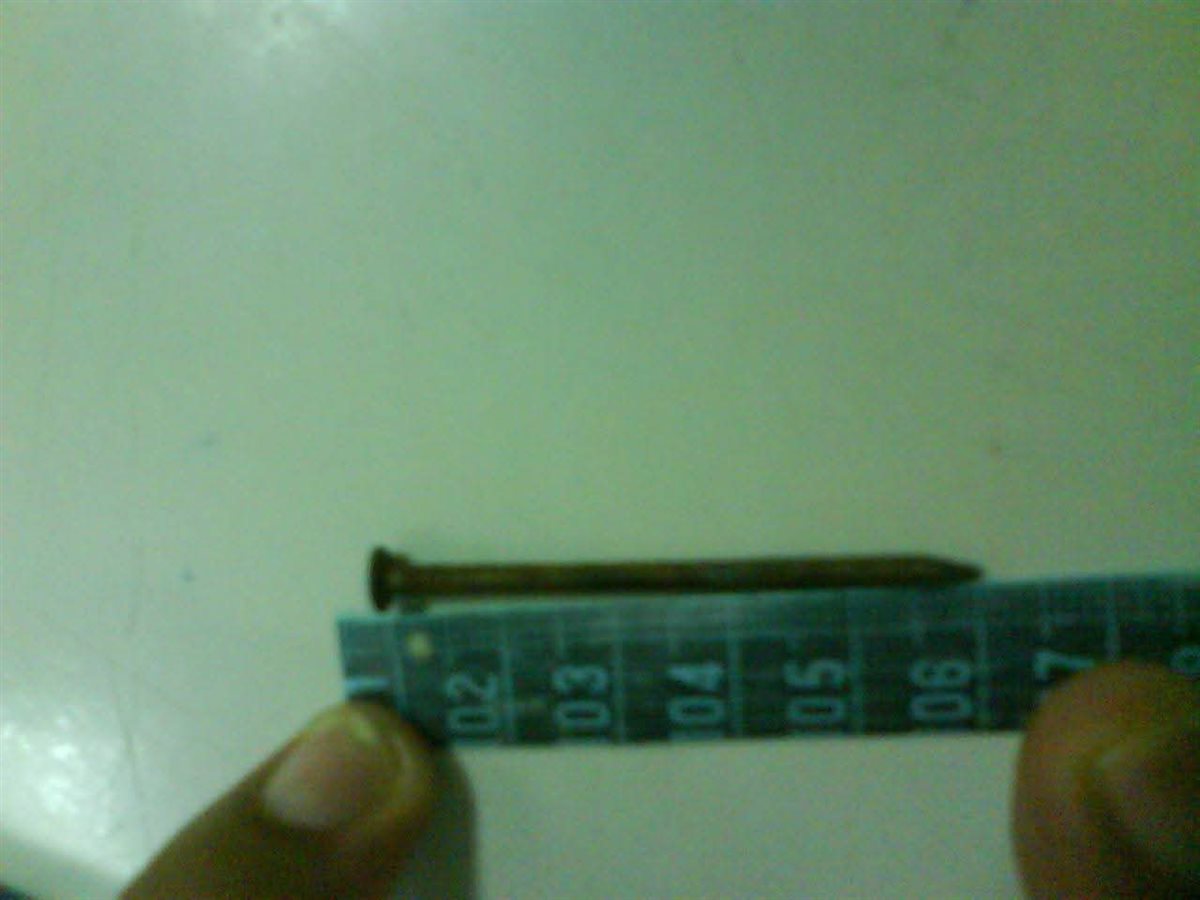 إنقاذ طفلة ابتلعت مسمارًا بمستشفى الأطفال التخصصي ببنها