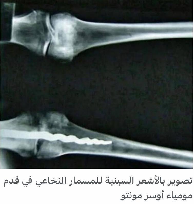 مسمار في قدم مومياء