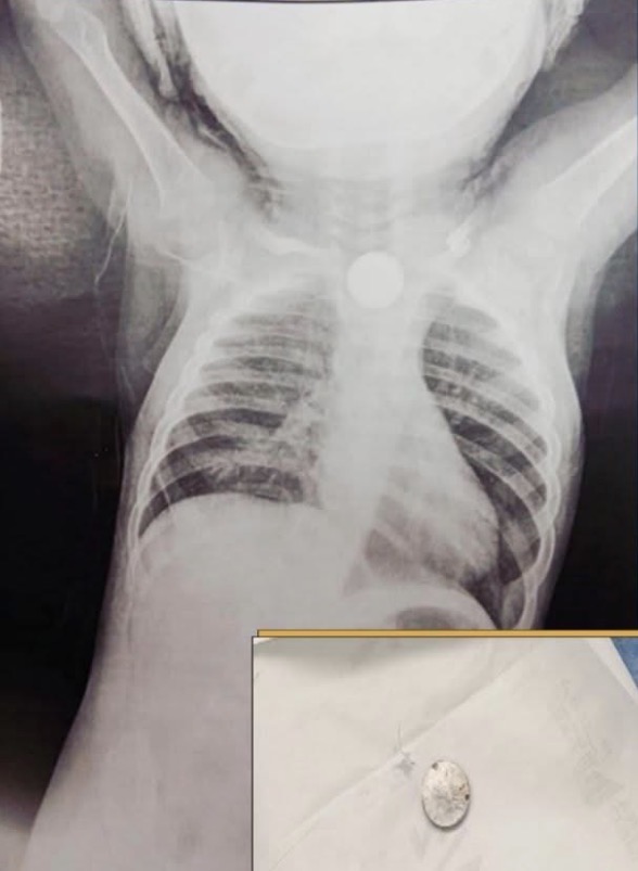 اشعة الطفل والبطارية المستخرجة