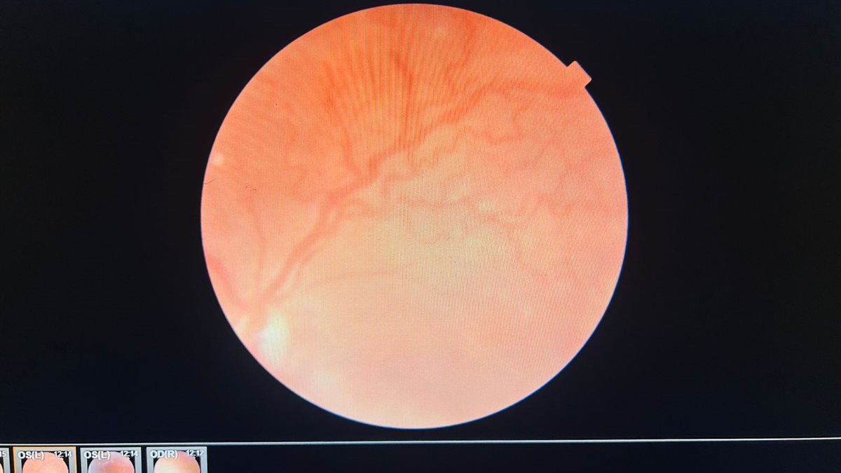 رمد المنصورة تنجح في تصوير قاع عين مولود خدج بتقنية OCT المتطورة