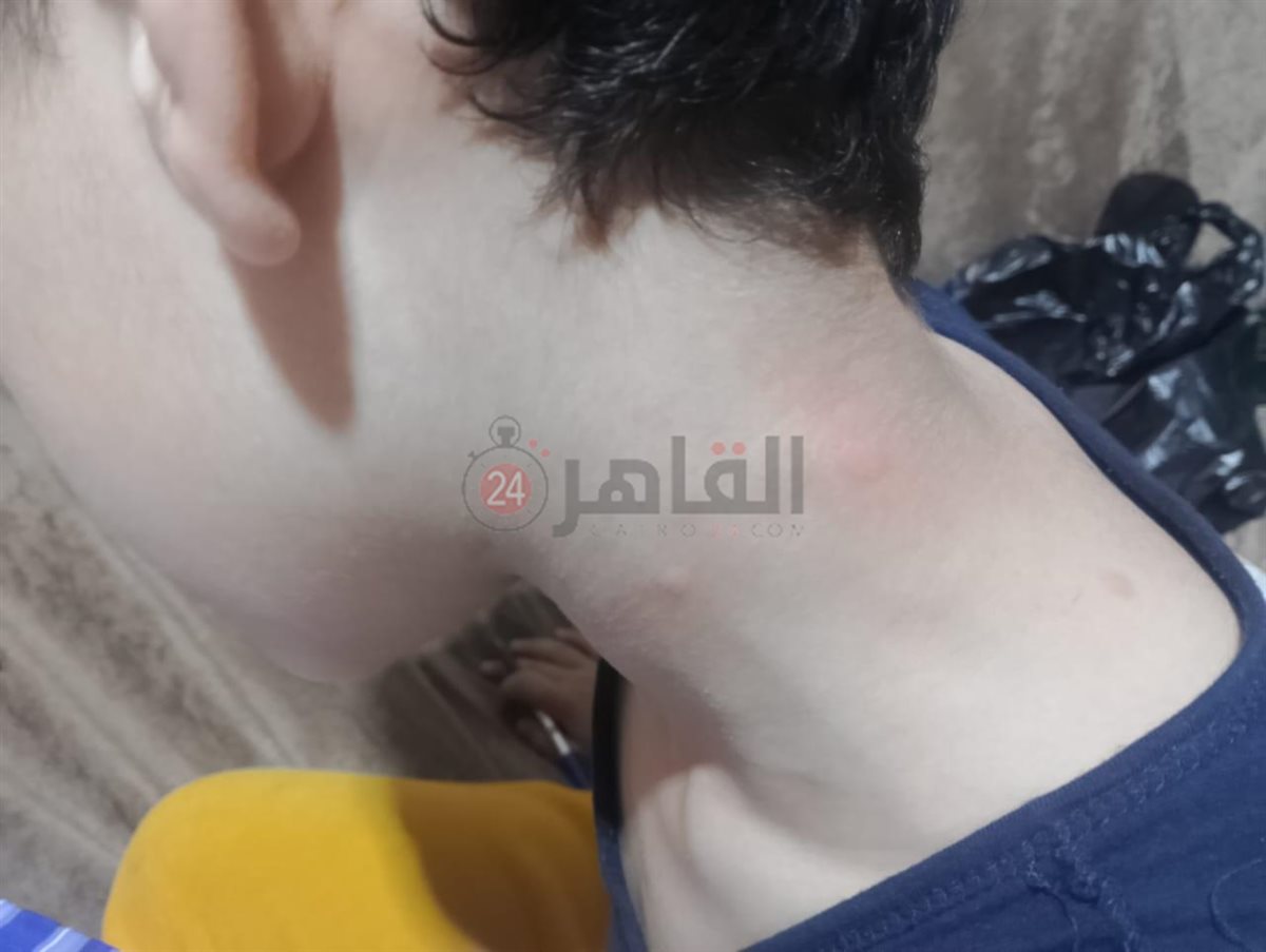 أولياء أمور مدرسة بالقاهرة يستغيثون من انتشار حشرات البق داخل الفصول