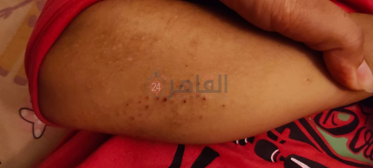 أولياء أمور مدرسة بالقاهرة يستغيثون من انتشار حشرات البق داخل الفصول