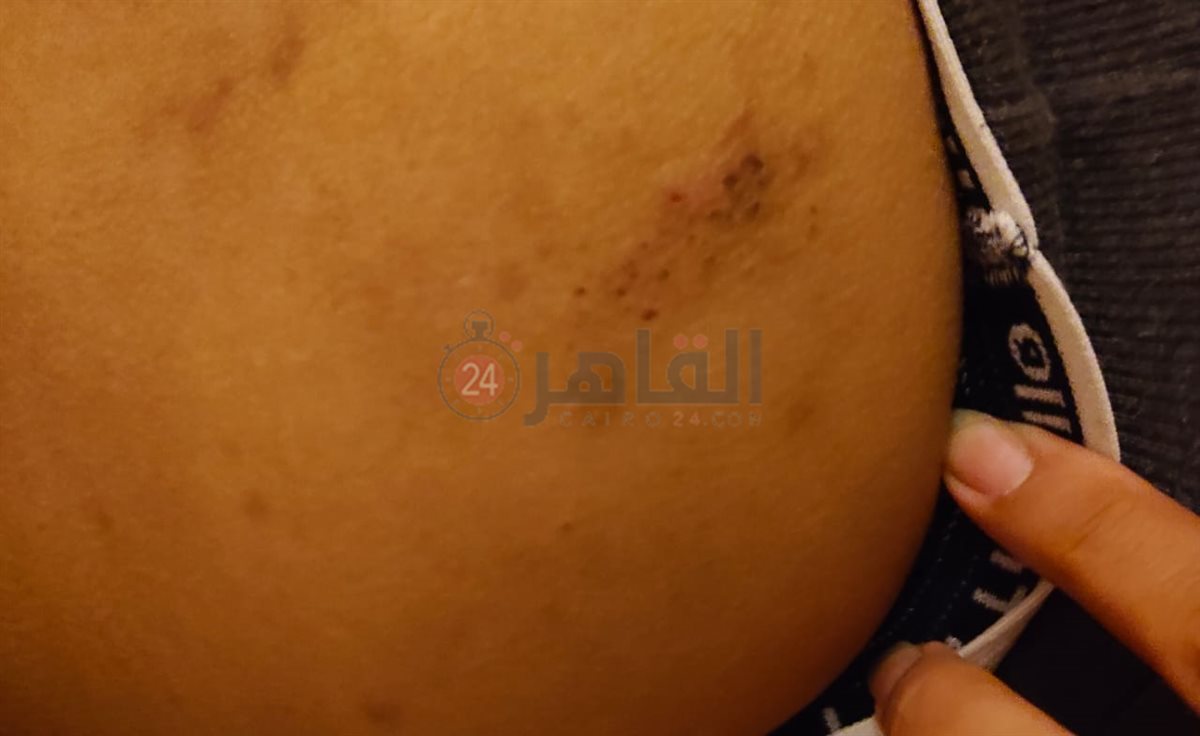 أولياء أمور مدرسة بالقاهرة يستغيثون من انتشار حشرات البق داخل الفصول