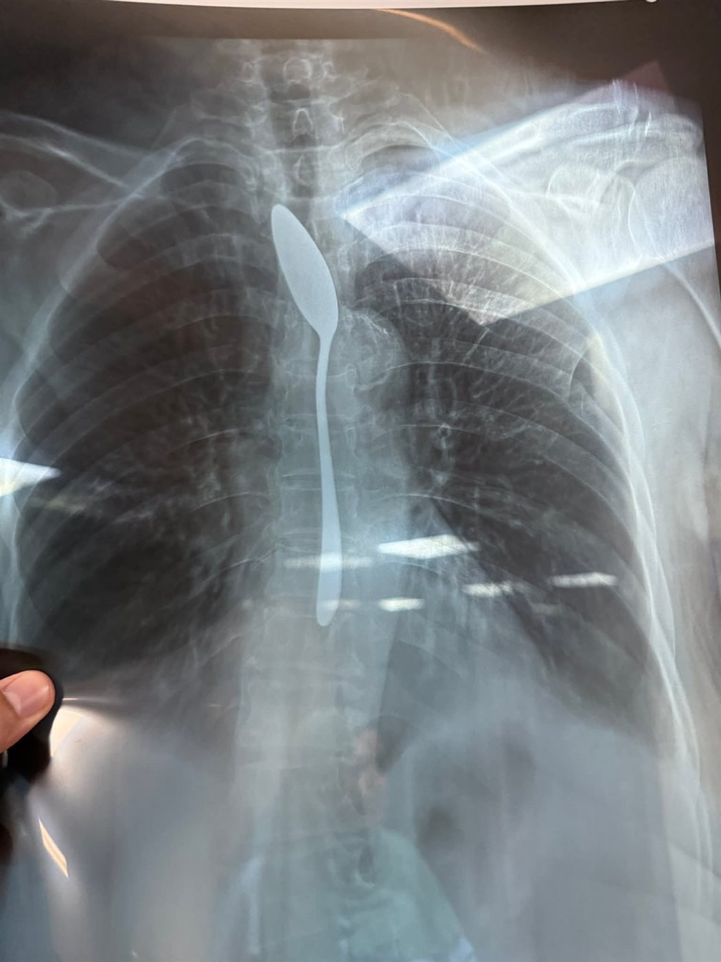 سيدة تبتلع معلقة شاي بالمنوفية