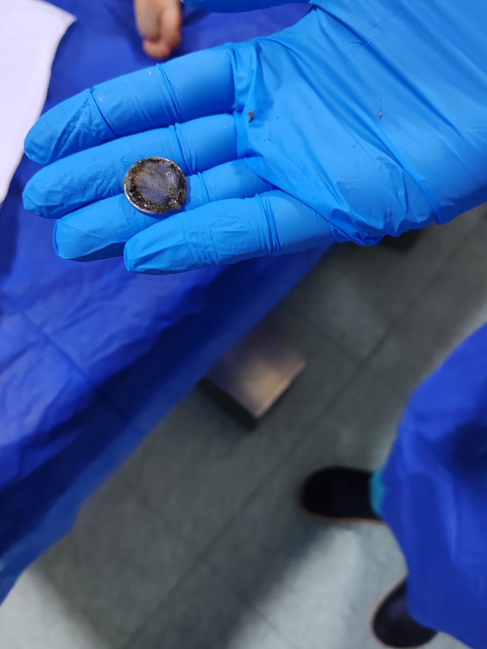 استخراج بطارية ابتلعها طفل بعمر 5 سنوات