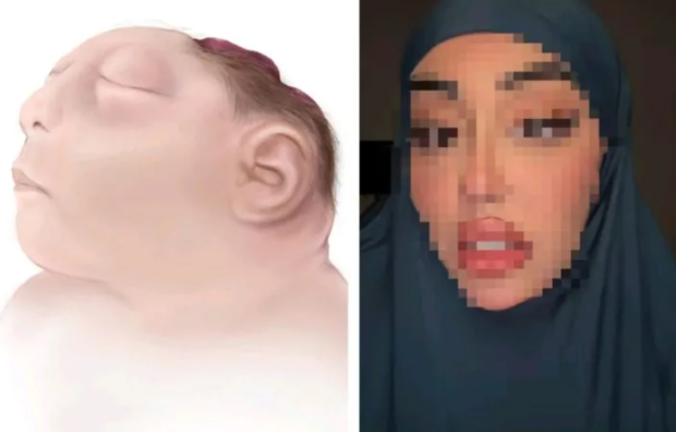 متلازمة الطفل الضفدع