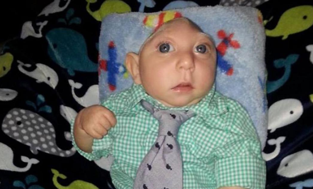 متلازمة الطفل الضفدع