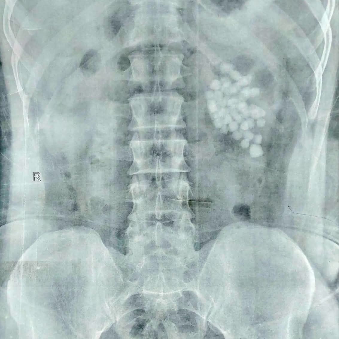 استخراج 58 حصوة من كلية مريض