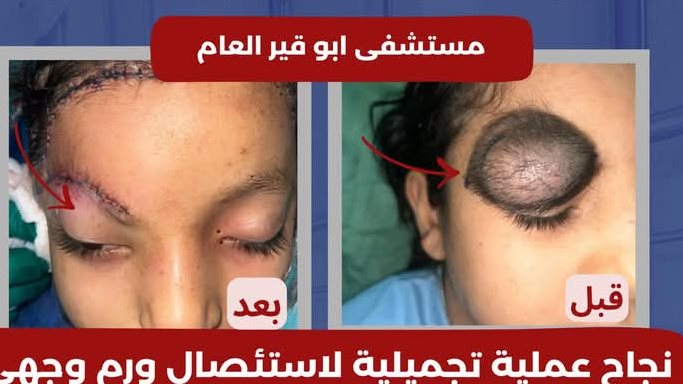 قبل وبعد العملية