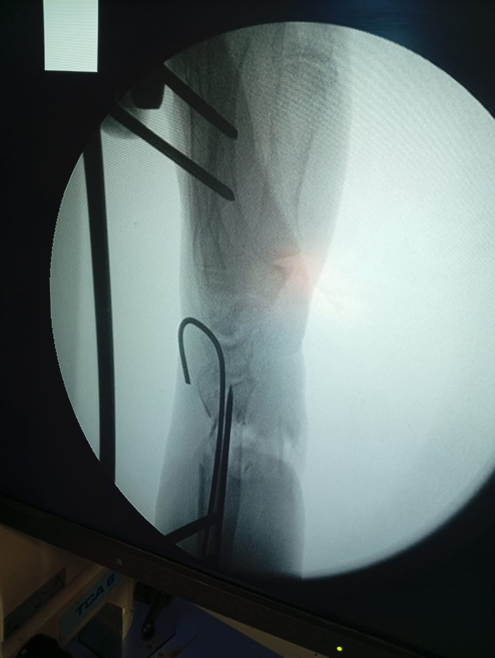 إنقاذ مسنة بمستشفى الفيوم العام بعد جراحة دقيقة في اليد