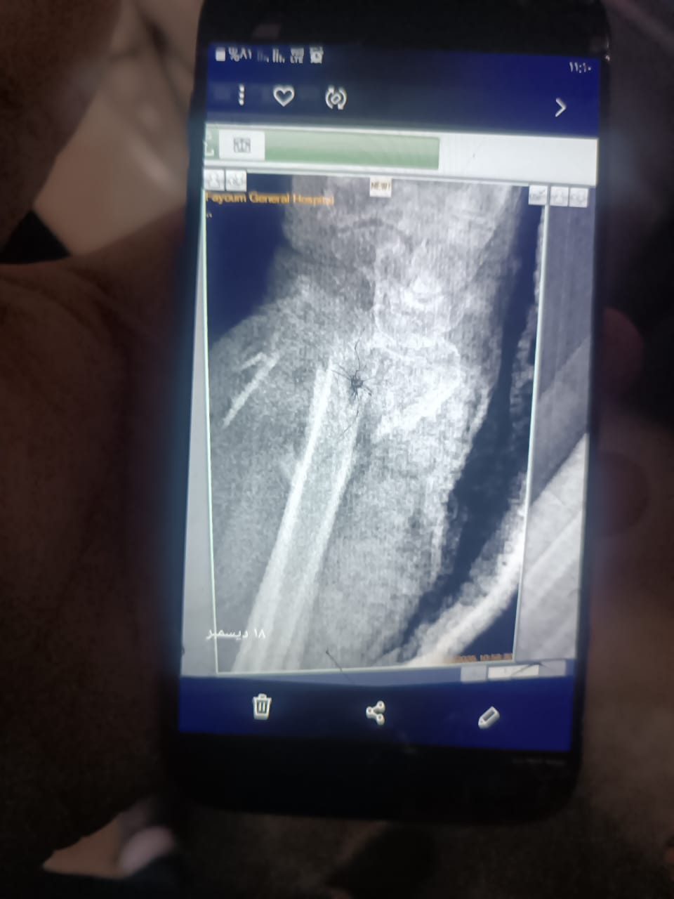 إنقاذ مسنة بمستشفى الفيوم العام بعد جراحة دقيقة في اليد