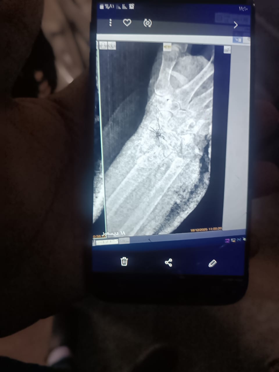 إنقاذ مسنة بمستشفى الفيوم العام بعد جراحة دقيقة في اليد