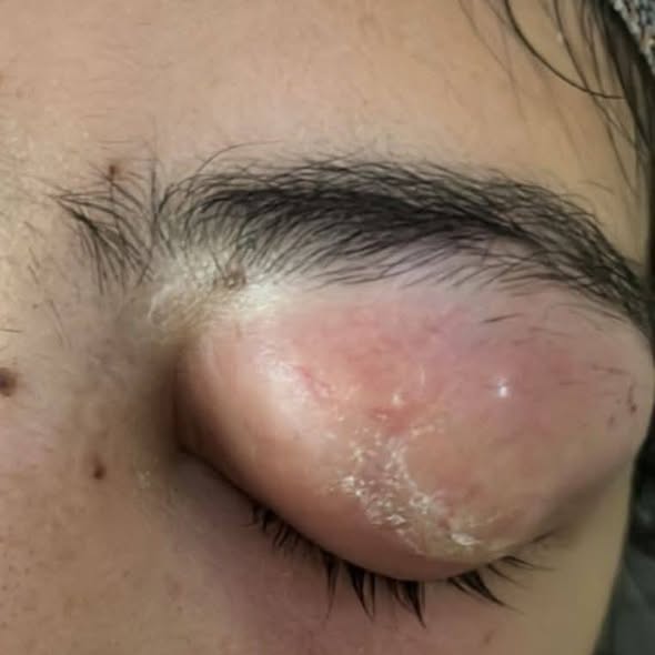 مستشفى الأزهر بأسيوط تعيد الرؤية لمريضة بعد استخراج جسم زجاجي مستقر بالجيب الأنفي أسفل العين منذ 10 سنوات