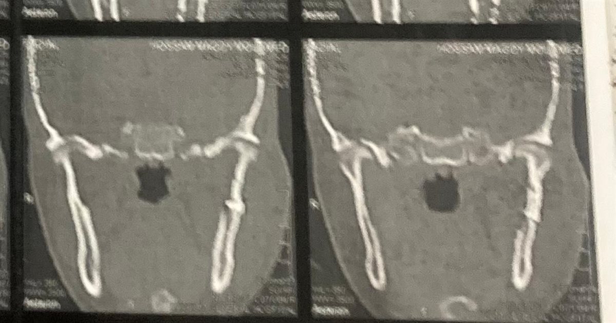 مستشفى الفيوم العام يجري جراحة دقيقة في الوجه والفكين لإنقاذ شاب مصاب بحادث سير