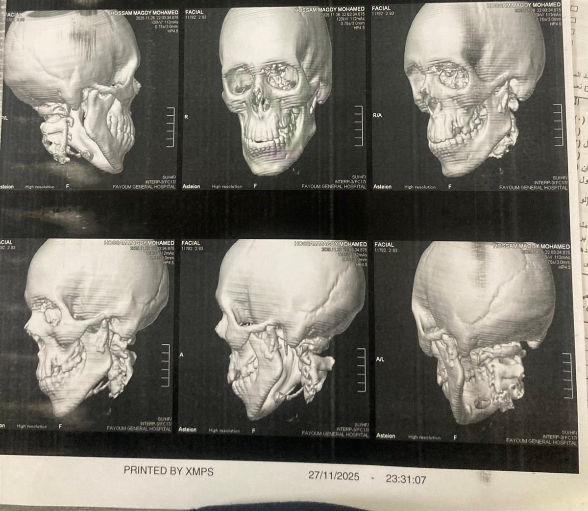 مستشفى الفيوم العام يجري جراحة دقيقة في الوجه والفكين لإنقاذ شاب مصاب بحادث سير